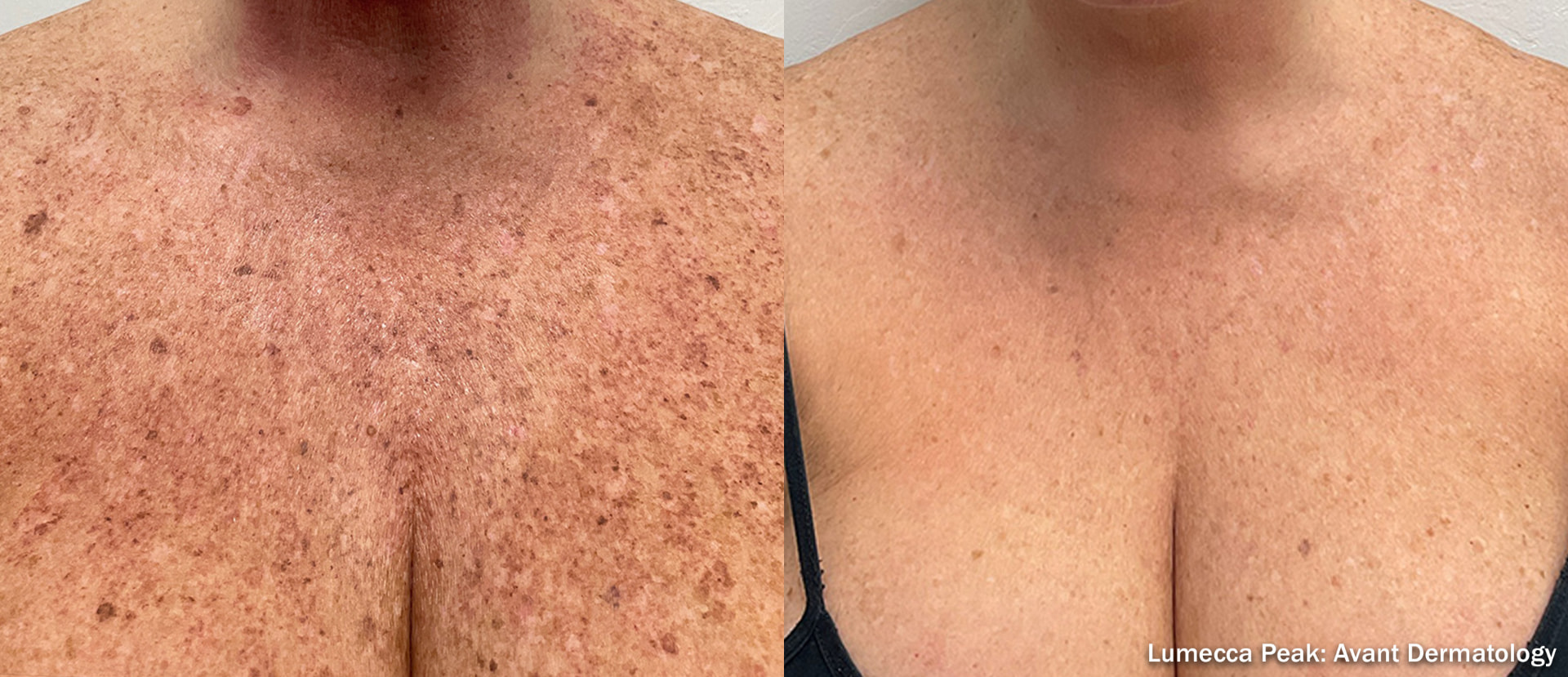 Before and after IPL treatment on a woman's lower neck and upper chest