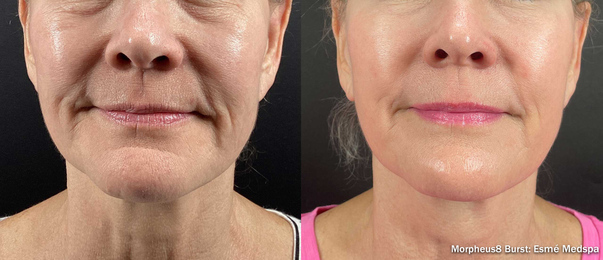 Before and after Morpheus8 treatment on a woman's lower face and neck, front view