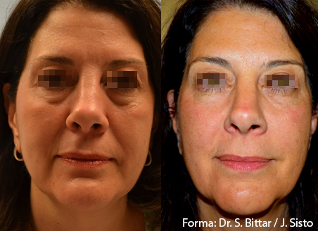 Before and after Forma treatment on a woman's face with the eyes obscured