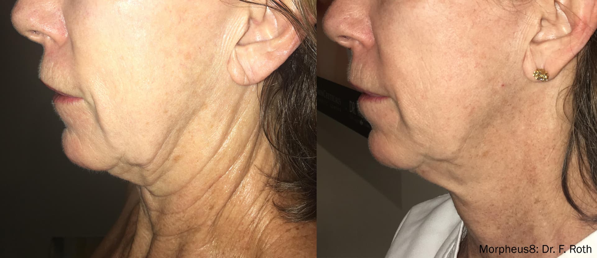 Before and after Morpheus8 treatment on a woman's left cheek, jawline, and neck