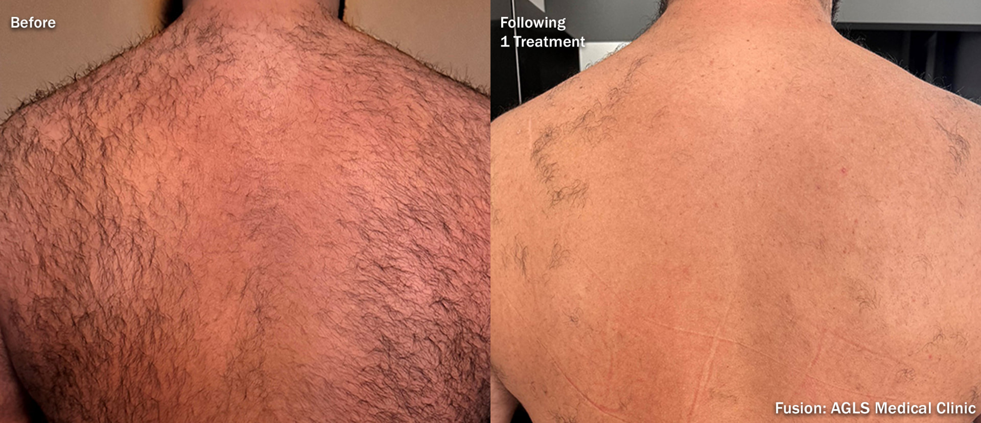 Before and after laser hair removal on a woman's upper back and shoulders