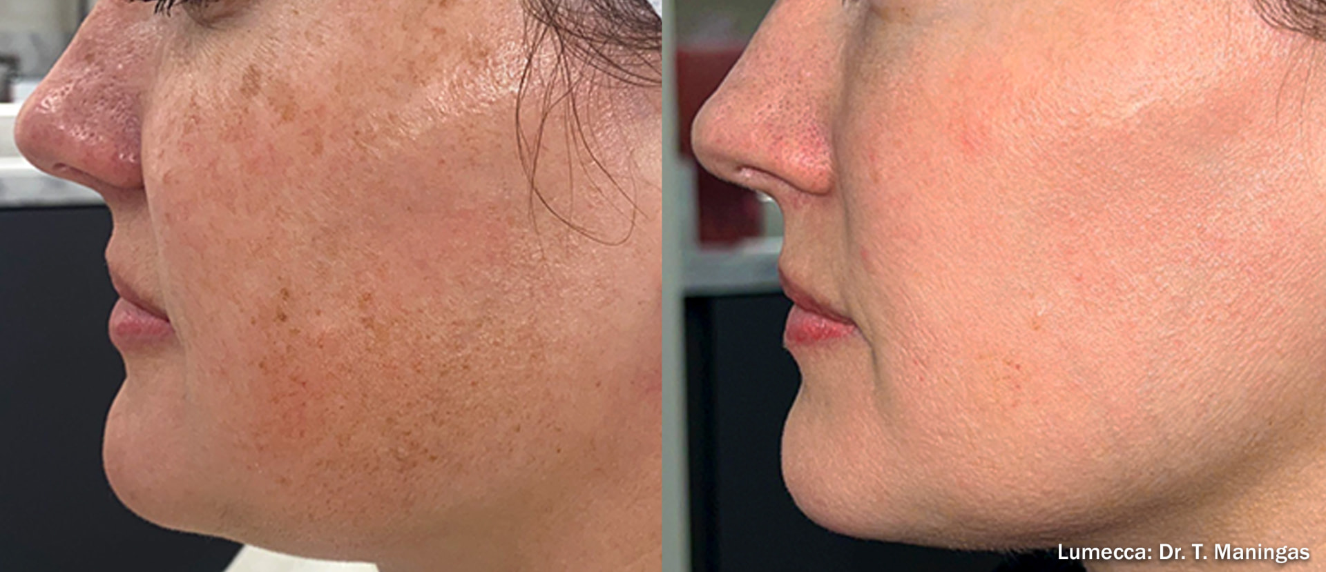 Before and after IPL treatment on the side of a woman's face