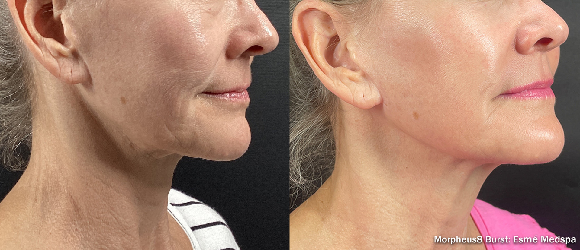 Before and after Morpheus8 treatment on a woman's right cheek, jawline, and neck