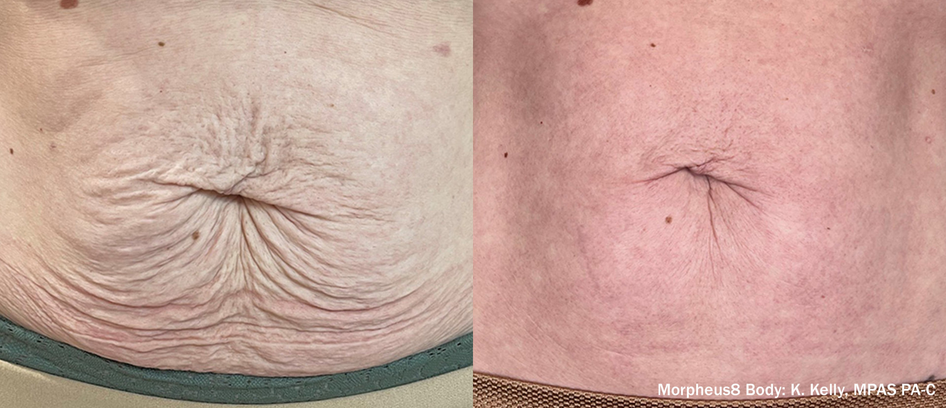 Before and after Morpheus8 Body treatment on a woman's abdomen
