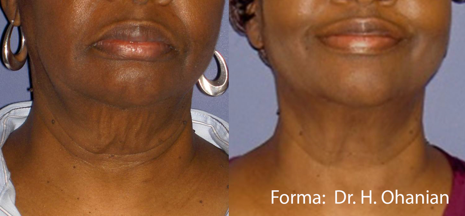 Before and after Forma treatment on a woman's neck and lower face, front view