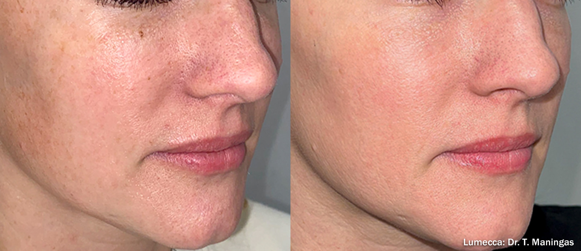 Before and after IPL treatment on a woman's right cheek, nose, and jawline