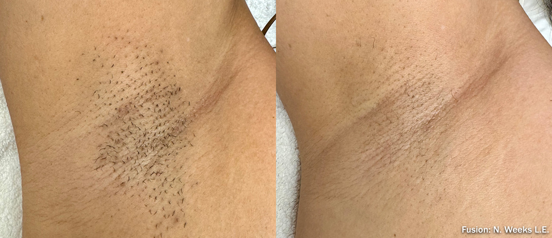 Before and after laser hair removal on a woman's underarm