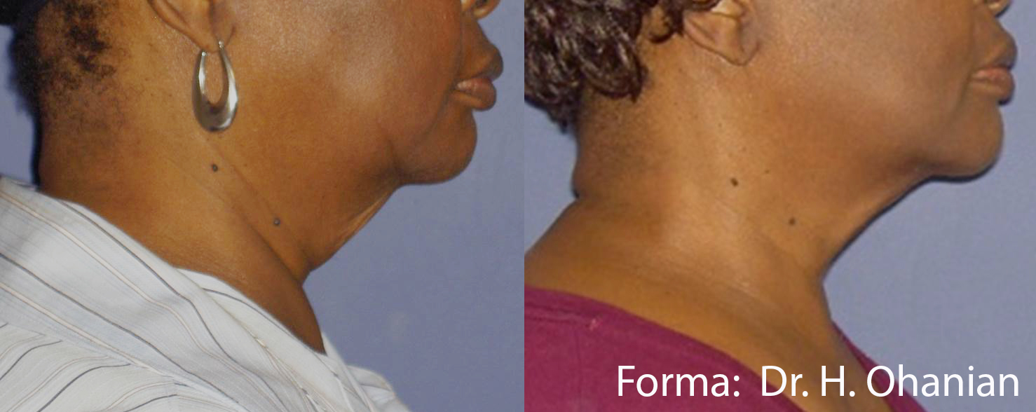 Before and after Forma treatment on a woman's neck and jawline, side view